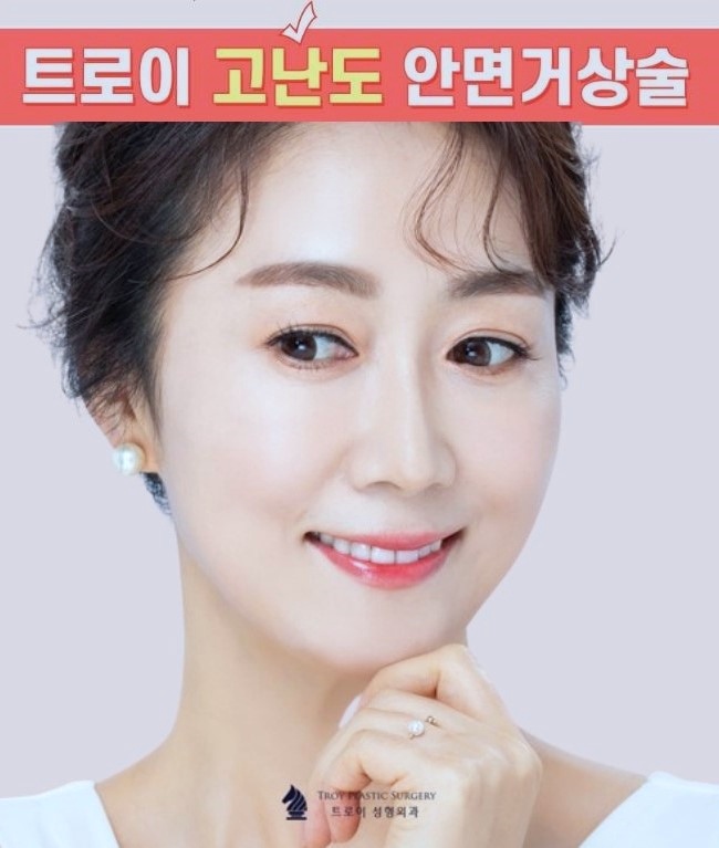 김포 안면거상 흉터 없이 잘하는 곳? 성형외과 관련 이미지 2