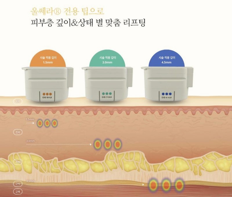 양천구피부과 울쎄라 리프팅 돈 낭비 안 하는 방법 관련 이미지 1