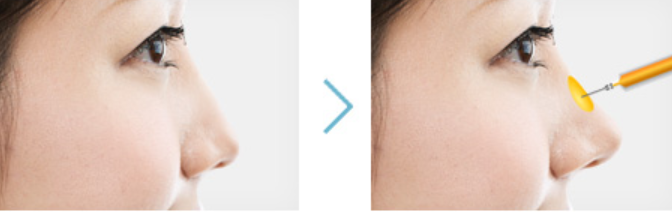 Best Place for Nose Filler in Mok-dong: If You Don’t Know This, It Will Fail image 5