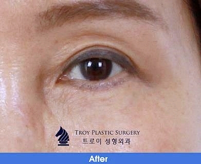 오목교역성형외과 중년쌍수 상안검 부작용 걱정? 이걸로 끝 관련 이미지 3