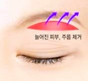 Mok-dong Eye Surgery: 3 Recommended Surgeries for Sagging Eyes (Upper Blepharoplasty / Brow Lift / Lower Blepharoplasty) image 3