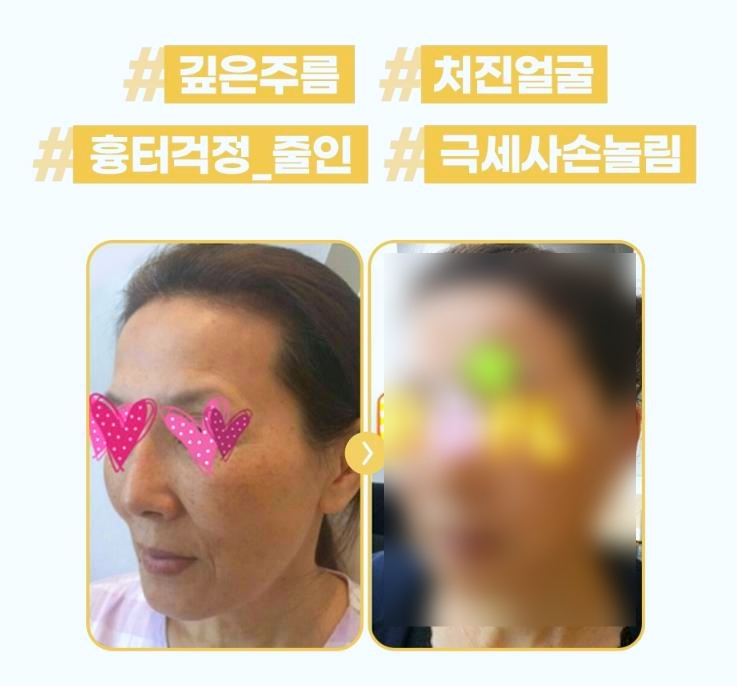목동리프팅피부과, 인기 솔루션 3가지 관련 이미지 3