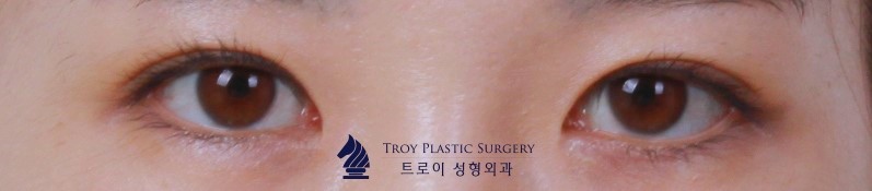 목동성형외과 선택 후회하기 싫으면 보세요 관련 이미지 3