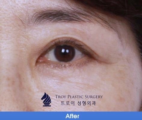 목동상안검, 처진 눈 관련 이미지 3