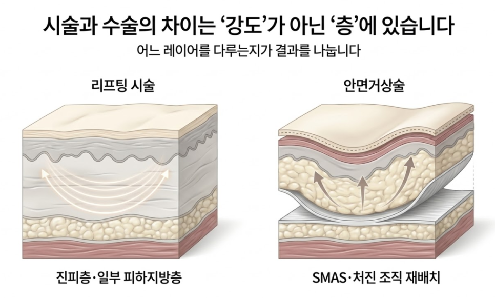 양천구 안면거상술, 리프팅 시술을 오래 했는데도 아쉬운 이유 관련 이미지 5