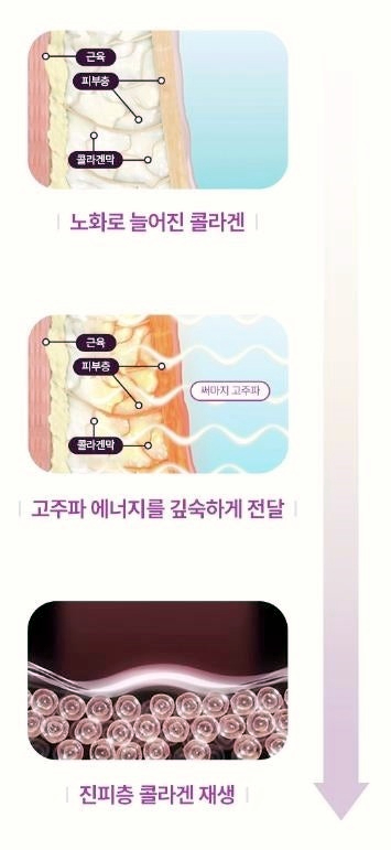 목동써마지 600샷은 300샷 2배 효과를 낸다? 아닙니다 관련 이미지 3