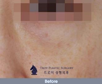 강서구눈밑지방재배치 효과 관련 이미지 2