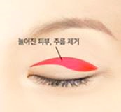 목동성형외과 추천 중년눈성형 3가지 관련 이미지 1