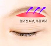 목동눈성형 처진 눈 수술 이것 3가지로 종결(상안검/눈썹하거상/하안검) 관련 이미지 3