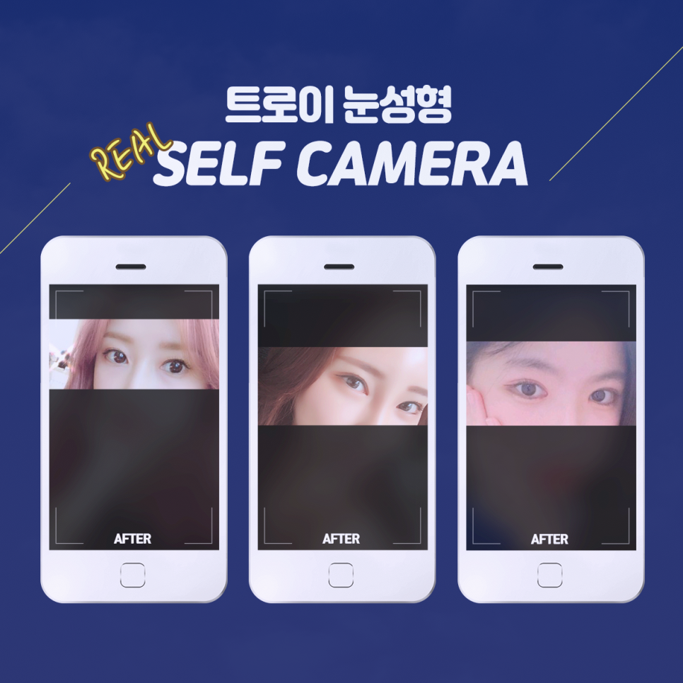 목동쌍꺼풀수술 매몰 vs 절개 뭐가 더 좋을까? 관련 이미지 3