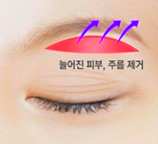 목동눈썹하거상 수술 흉터 관련 이미지 1