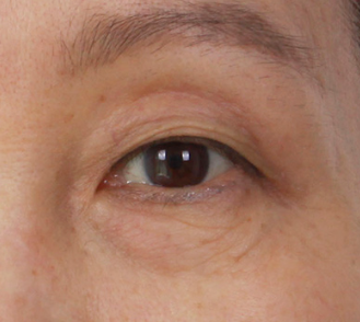 Gimpo Plastic Surgery: Upper Blepharoplasty or Eyebrow Lift? Which Droopy Eye Surgery Is Right for Me? image 2