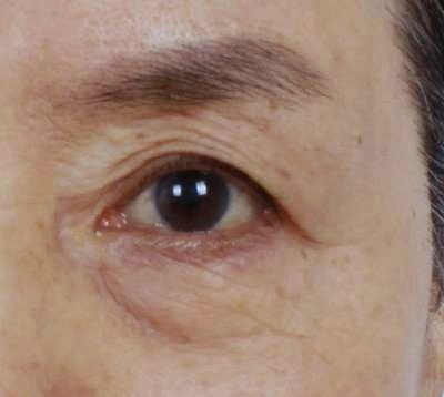 Mokdong Station Plastic Surgery: 3 Types of Surgery for Drooping Eyes (Upper Blepharoplasty / Brow Lift / Lower Blepharoplasty) image 2
