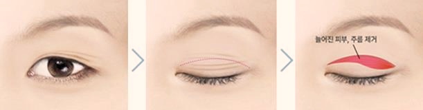 목동상안검 처진 눈 해결, 이러면 성공률 올라갑니다 관련 이미지 1