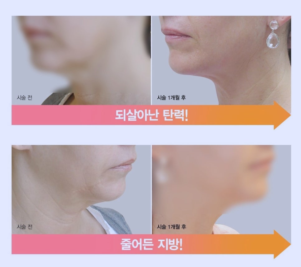 목동인모드 리프팅 수술없이 작은 얼굴 만드는법 관련 이미지 5