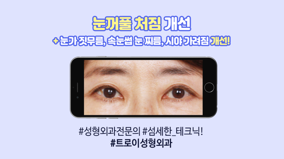 목동 트로이성형외과 동안성형으로 유명한 이유 관련 이미지 3
