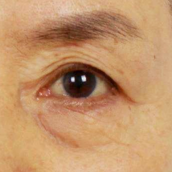 Mokdong Lower Blepharoplasty Surgery: Worried About Ectropion Side Effects? image 2