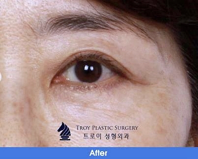 오목교역성형외과 중년쌍수 상안검 부작용 걱정? 이걸로 끝 관련 이미지 4