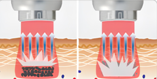 목동 문신제거, 흉터 없이 안전하게 가능할까? 관련 이미지 3
