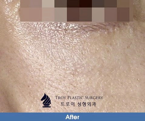 목동성형외과 중년눈성형 잘하는 곳에서 추천하는 수술 4가지 관련 이미지 4
