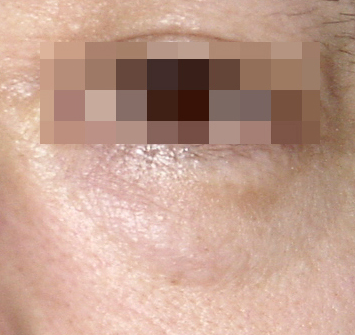 Mokdong Under-Eye Fat Repositioning Effect? When Is It Needed? We’ll Tell You Everything image 3