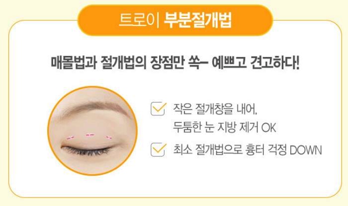 강서구쌍꺼풀 매몰 vs 절개, 모르고 받으면 후회합니다 관련 이미지 4