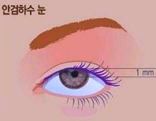 목동눈매교정 흉터걱정 된다면 비절개로 관련 이미지 3