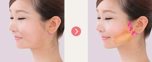 목동안면거상 흉터 줄일 수 있는 방법 1가지 관련 이미지 1