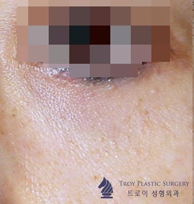 목동 눈밑지방재배치 흉터 안 남는 성형외과 찾는 팁 관련 이미지 3