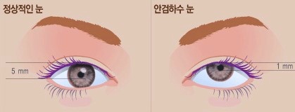 목동눈성형 졸리눈, 비절개눈매교정으로 해결할 수 있어요? 관련 이미지 1