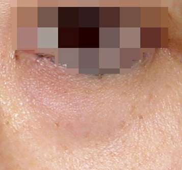 Mokdong Under-Eye Fat Repositioning Effect? When Is It Needed? We’ll Tell You Everything image 2
