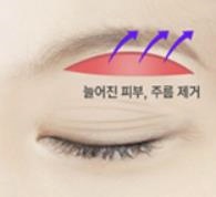 Gimpo Plastic Surgery: Upper Blepharoplasty or Eyebrow Lift? Which Droopy Eye Surgery Is Right for Me? image 3