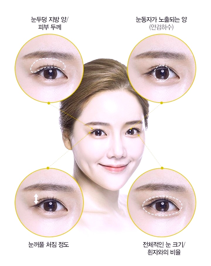 김포쌍수 인라인 vs 아웃라인 나에게 어울리는 라인 찾는 법 관련 이미지 1
