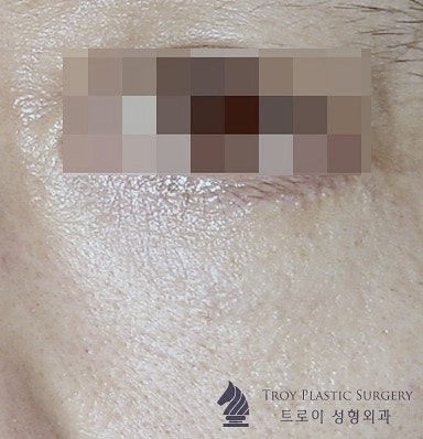 Mok-dong Eye Surgery: 3 Recommended Surgeries for Sagging Eyes (Upper Blepharoplasty / Brow Lift / Lower Blepharoplasty) image 6