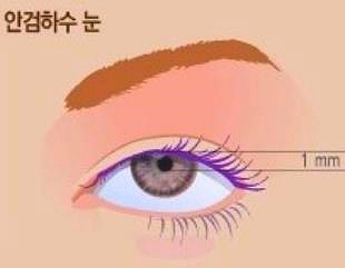 목동눈매교정 잘하는 곳 이것 2가지 꼭 확인하세요 관련 이미지 3