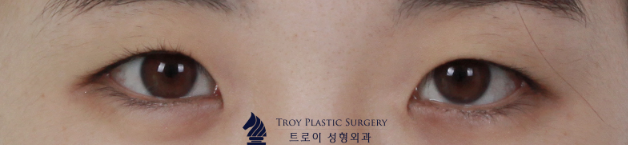 Gimpo Eye Surgery: How to Reduce the Horizontal Length of the Eyes with Inner and Outer Corner Surgery image 4