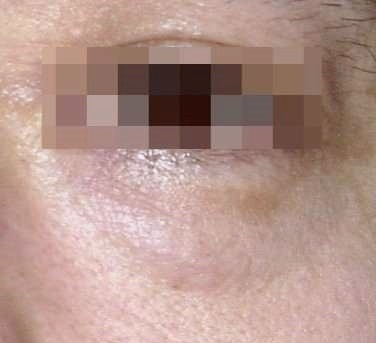Mokdong Station Plastic Surgery: 3 Types of Surgery for Drooping Eyes (Upper Blepharoplasty / Brow Lift / Lower Blepharoplasty) image 3