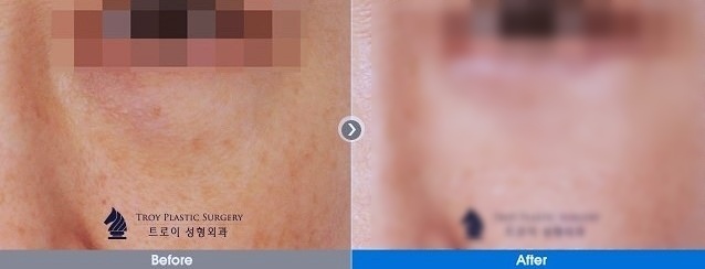 강서구눈밑지방재배치로 다크서클, 볼록살 없앨 수 있어요? 관련 이미지 2