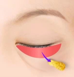 Mokdong Under-Eye Fat Repositioning Effect? When Is It Needed? We’ll Tell You Everything image 1