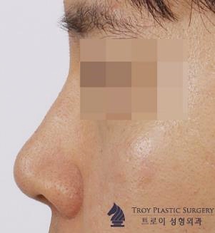 목동필러 잘하는 곳에서 추천하는 부위 3군데 관련 이미지 1