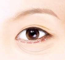 Mok-dong Eye Surgery: 3 Recommended Surgeries for Sagging Eyes (Upper Blepharoplasty / Brow Lift / Lower Blepharoplasty) image 5