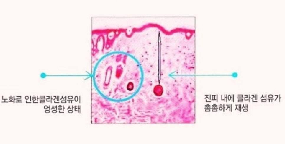 강서구실리프팅 &lsquo;이것&rsquo; 하나면 통증 없이 가능합니다 관련 이미지 2