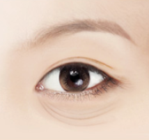 Mokdong Lower Blepharoplasty Surgery: Worried About Ectropion Side Effects? image 1