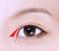 강서구 앞트임 뒤트임 중 나에게 필요한 수술은? 관련 이미지 1