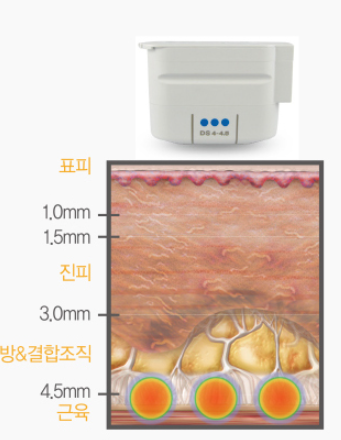 울쎄라 300샷, 600샷... 샷 수, 정말 중요할까요? 관련 이미지 3