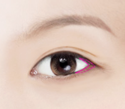 Gimpo Eye Surgery: How to Reduce the Horizontal Length of the Eyes with Inner and Outer Corner Surgery image 2
