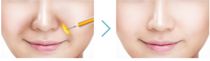 Mokdong Station Fillers: What’s the Most Effective Choice by Facial Area? image 4