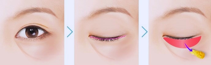 강서구눈밑지방재배치로 다크서클, 볼록살 없앨 수 있어요? 관련 이미지 1