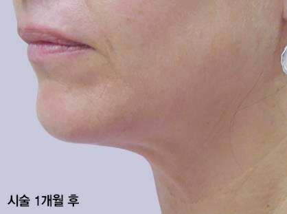 목동인모드 효과 관련 이미지 3
