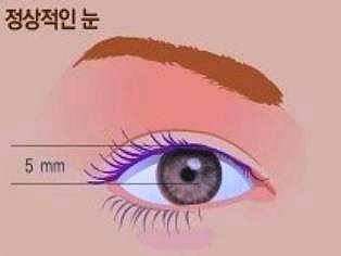 목동눈매교정 흉터걱정 된다면 비절개로 관련 이미지 2